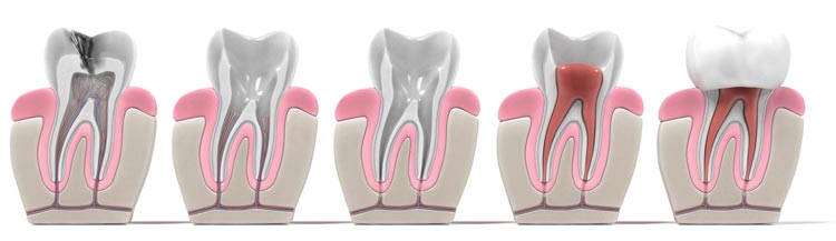 koreninsko zdravljenje koreninsko zdravljenje